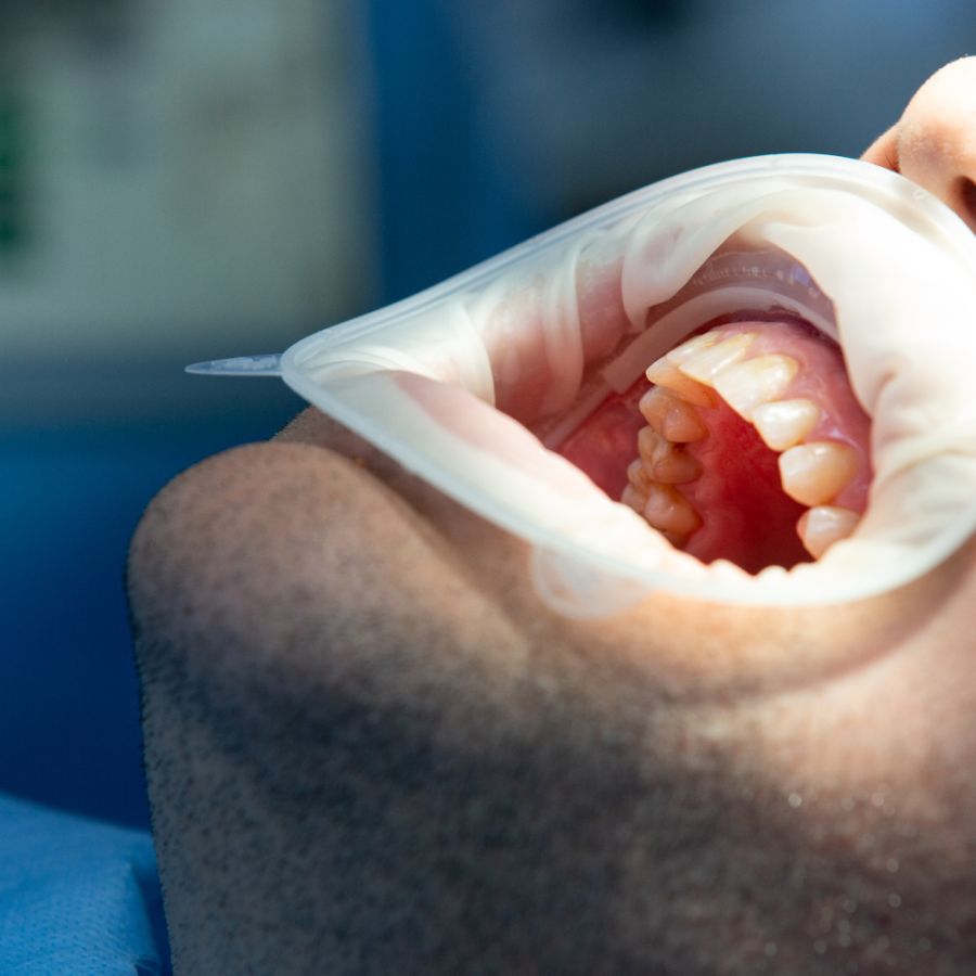 Pacient in dental clinic with a mouth shield