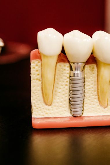 dental implant model
